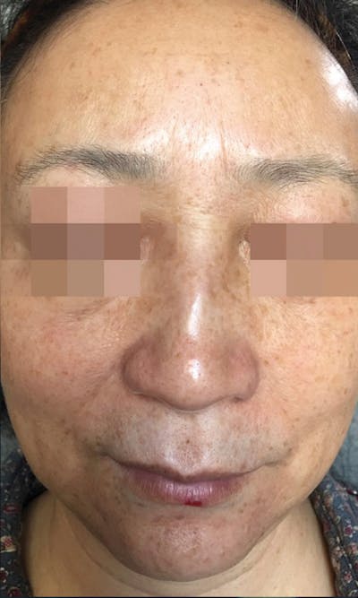 Cosmelan Peel Before & After Gallery - Patient 145355992 - Image 1