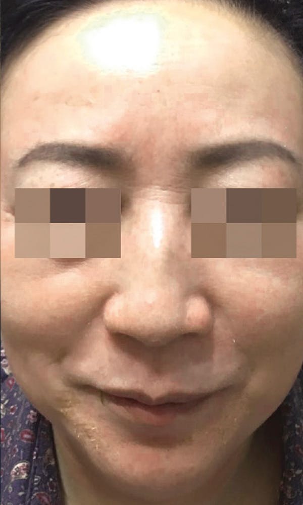 Cosmelan Peel Before & After Gallery - Patient 145355992 - Image 2