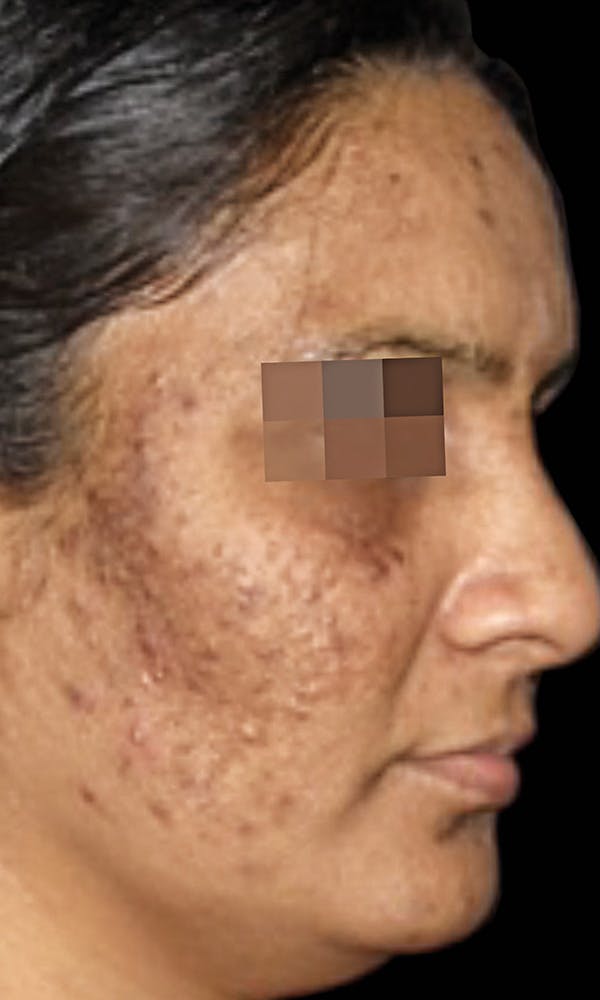 Cosmelan Peel Before & After Gallery - Patient 145355993 - Image 1