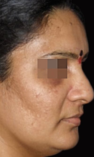 Cosmelan Peel Before & After Gallery - Patient 145355993 - Image 2