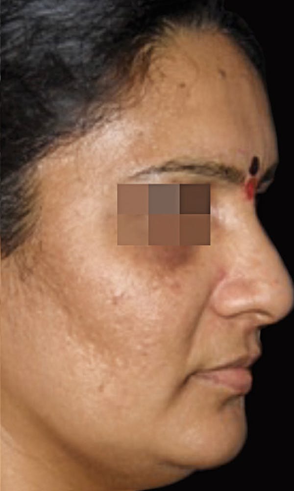 Cosmelan Peel Before & After Gallery - Patient 145355993 - Image 2