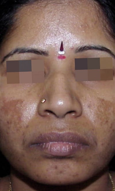 Cosmelan Peel Before & After Gallery - Patient 145355994 - Image 1