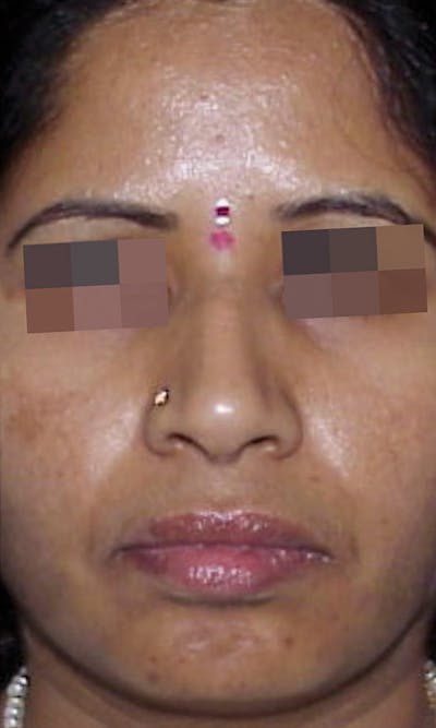 Cosmelan Peel Before & After Gallery - Patient 145355994 - Image 2