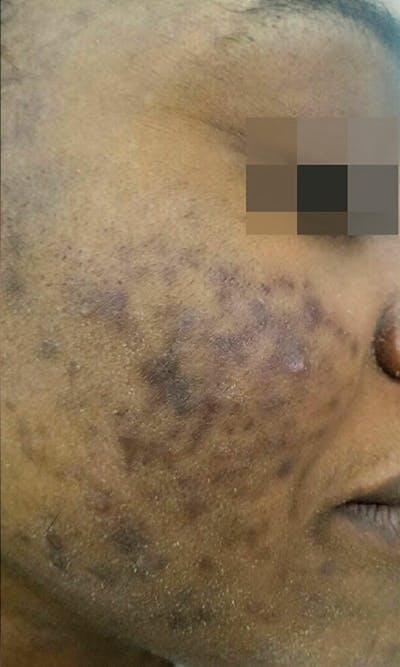 Cosmelan Peel Before & After Gallery - Patient 145355995 - Image 1