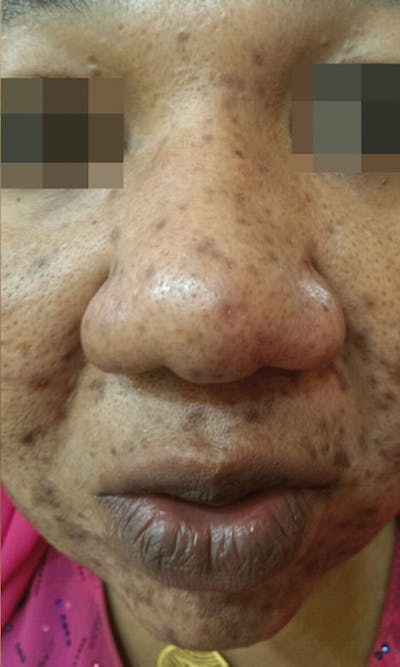 Cosmelan Peel Before & After Gallery - Patient 145355996 - Image 1