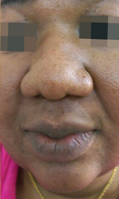 Cosmelan Peel Before & After Gallery - Patient 145355996 - Image 2