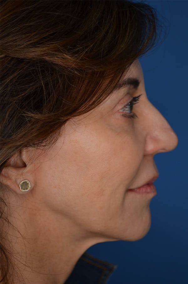 Facelift Before & After Gallery - Patient 148316907 - Image 1