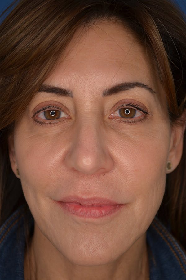 Facelift Before & After Gallery - Patient 148316907 - Image 3
