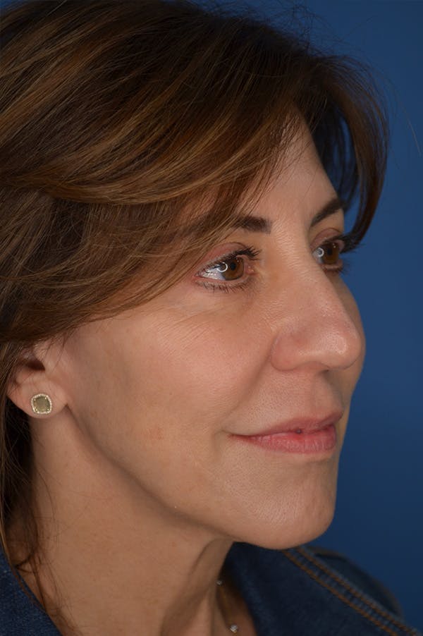 Facelift Before & After Gallery - Patient 148316907 - Image 5