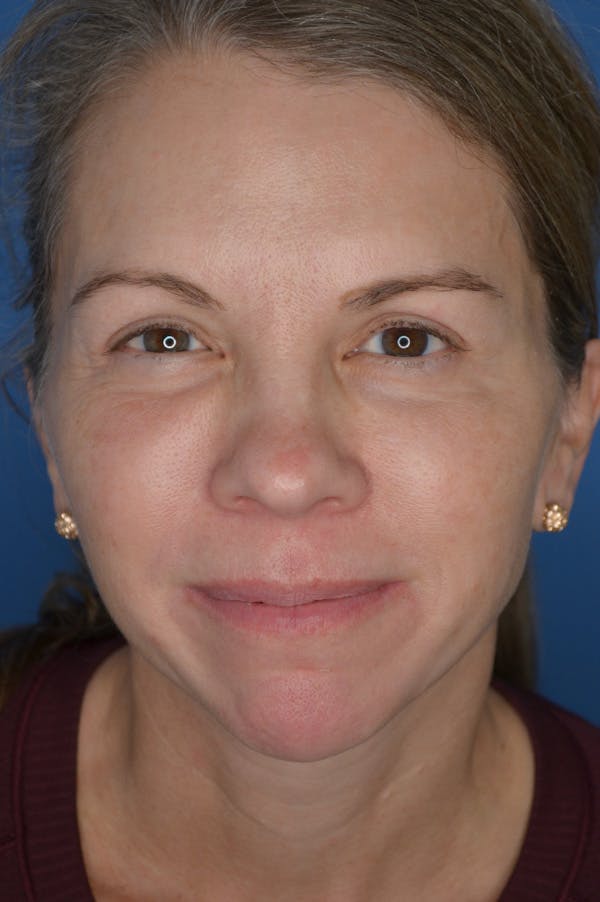 Eyelid Surgery Before & After Gallery - Patient 148316911 - Image 2
