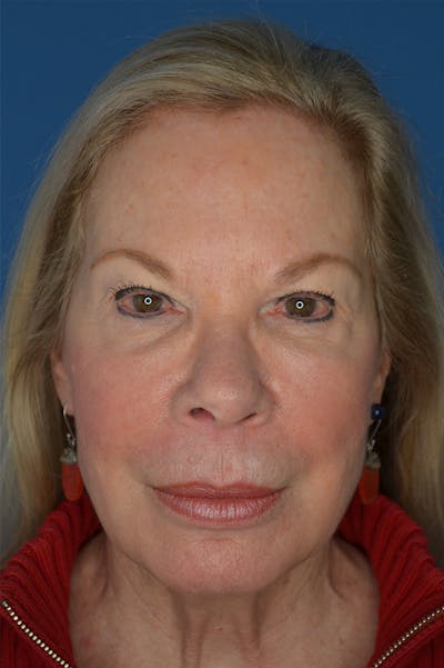 Facelift Before & After Gallery - Patient 148316914 - Image 1