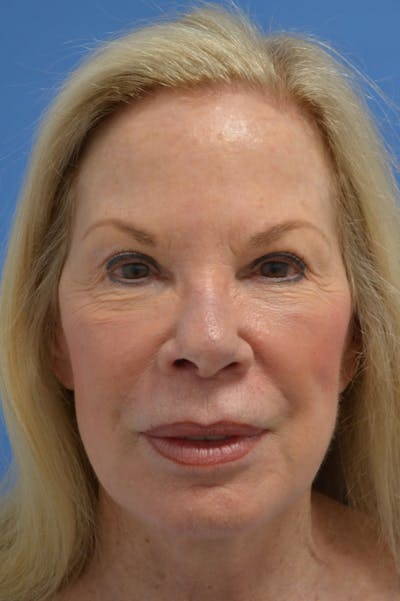 Eyelid Surgery Before & After Gallery - Patient 148316913 - Image 2