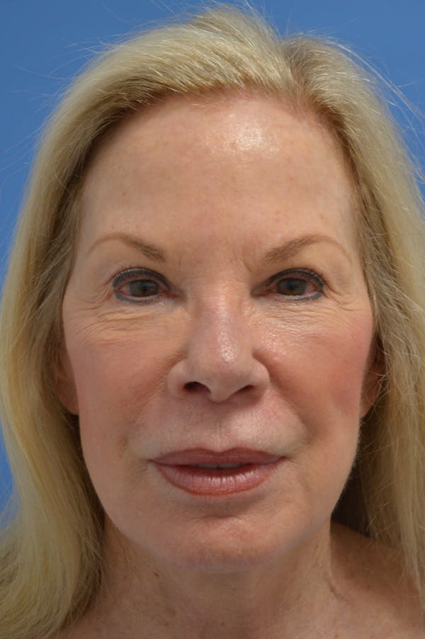Facelift Before & After Gallery - Patient 148316914 - Image 2