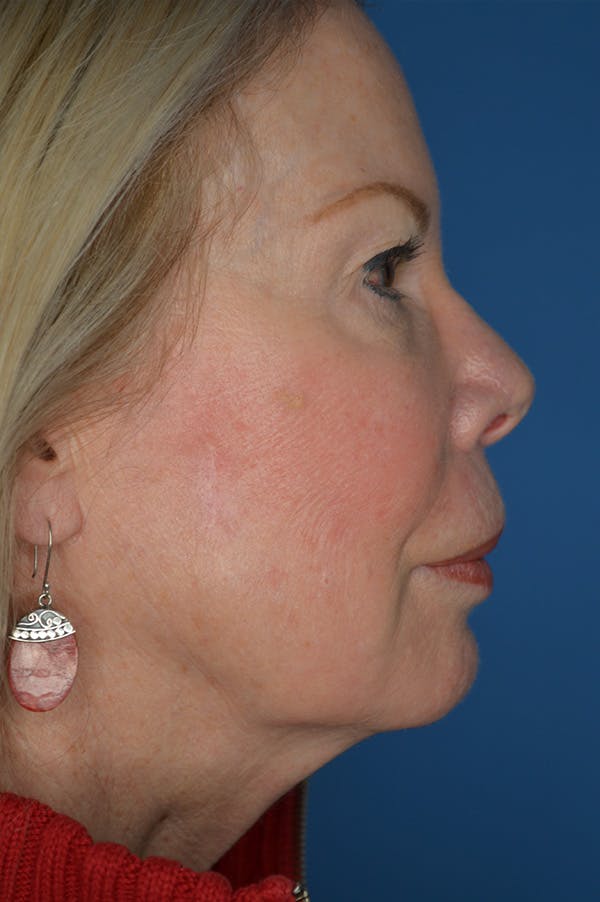Facelift Before & After Gallery - Patient 148316914 - Image 3