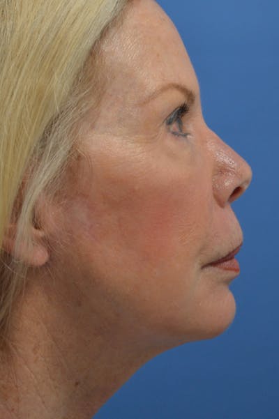 Eyelid Surgery Before & After Gallery - Patient 148316913 - Image 4