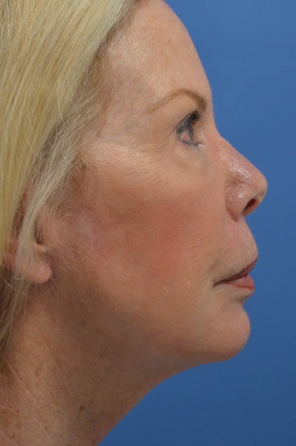 Facelift Before & After Gallery - Patient 148316914 - Image 4