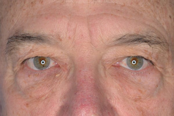 Eyelid Surgery Before & After Gallery - Patient 148316916 - Image 1