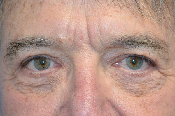Eyelid Surgery Before & After Gallery - Patient 148316916 - Image 2