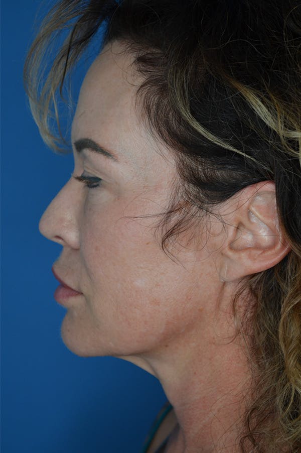Eyelid Surgery Before & After Gallery - Patient 148316923 - Image 1