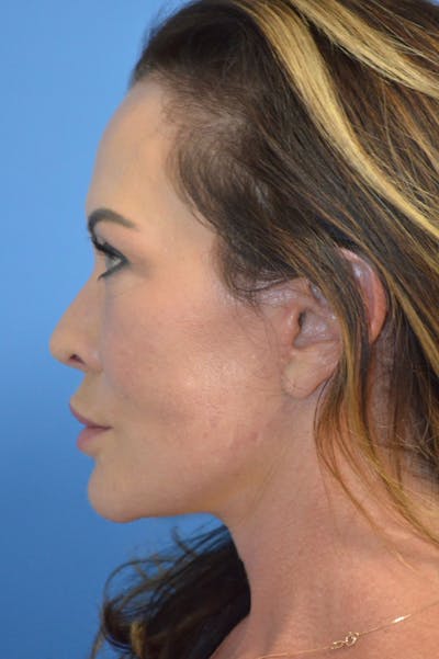 Facelift Before & After Gallery - Patient 148316925 - Image 2