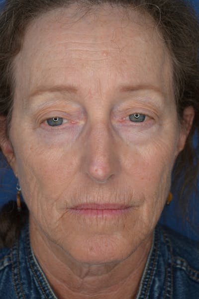 Eyelid Surgery Before & After Gallery - Patient 148316928 - Image 1