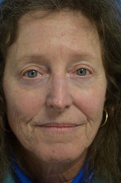 Eyelid Surgery Before & After Gallery - Patient 148316928 - Image 2