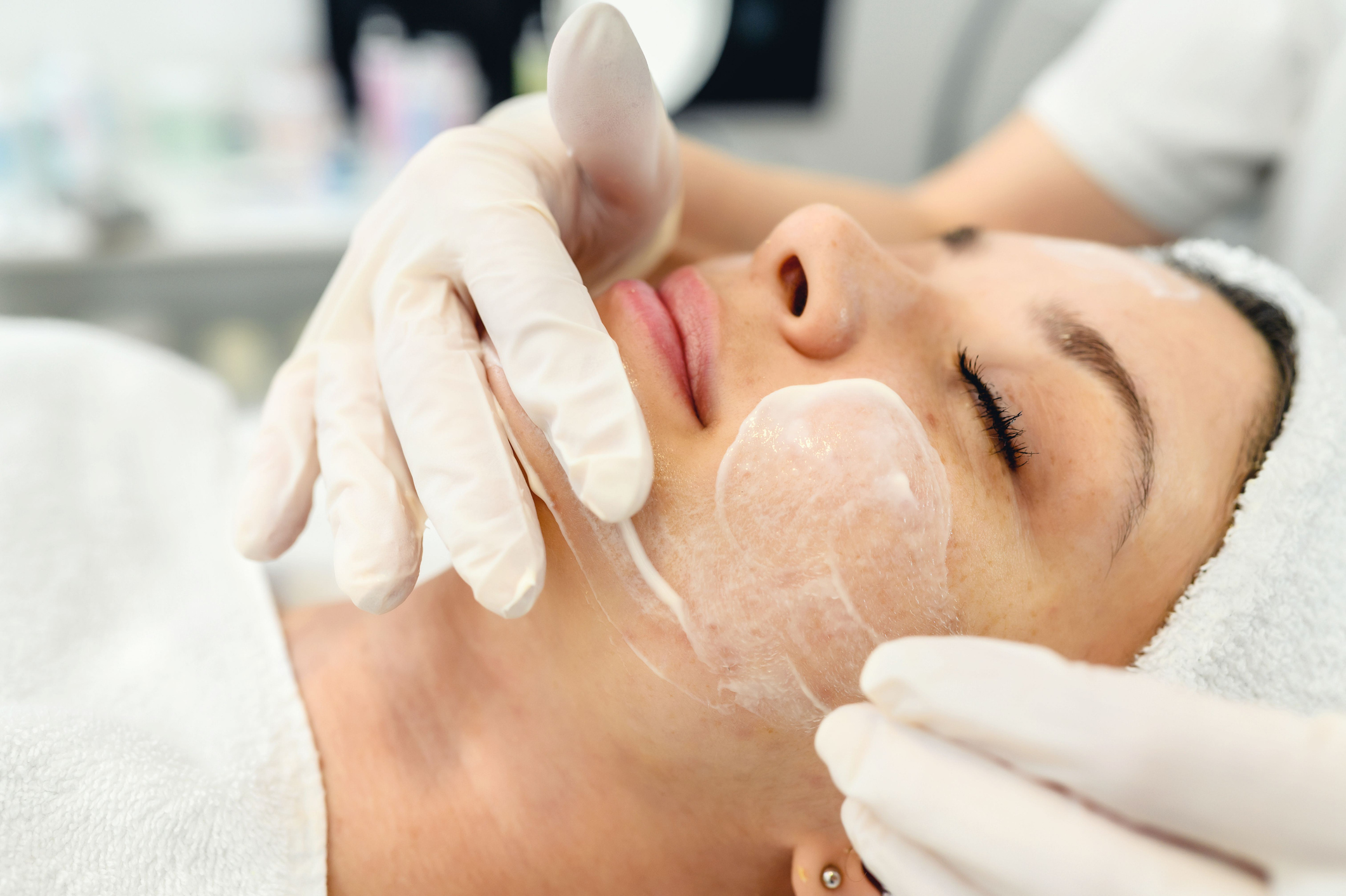 Woman on table receiving a chemical peel on face