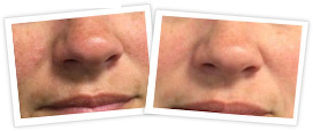 Chemical Peel / Skin Resurfacing Before & After Gallery - Patient 155012 - Image 1