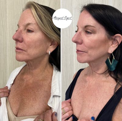  C02 Laser Before & After Gallery - Patient 193328 - Image 1