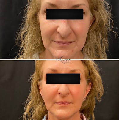 Dermal Filler Before & After Gallery - Patient 110689 - Image 1