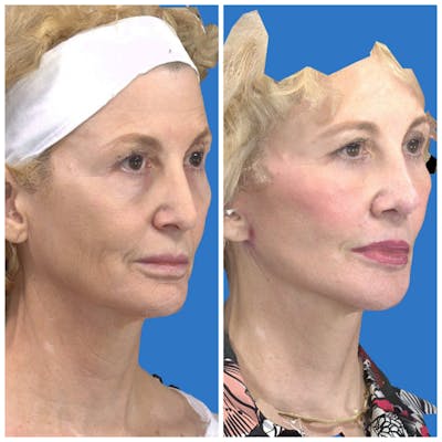 Facelift Before & After Gallery - Patient 14282332 - Image 2