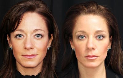 Aesthetic Facial Balancing Before & After Gallery - Patient 11681581 - Image 1