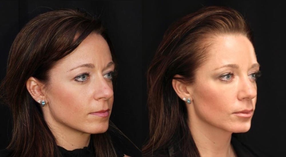 Aesthetic Facial Balancing Before & After Gallery - Patient 11681581 - Image 2