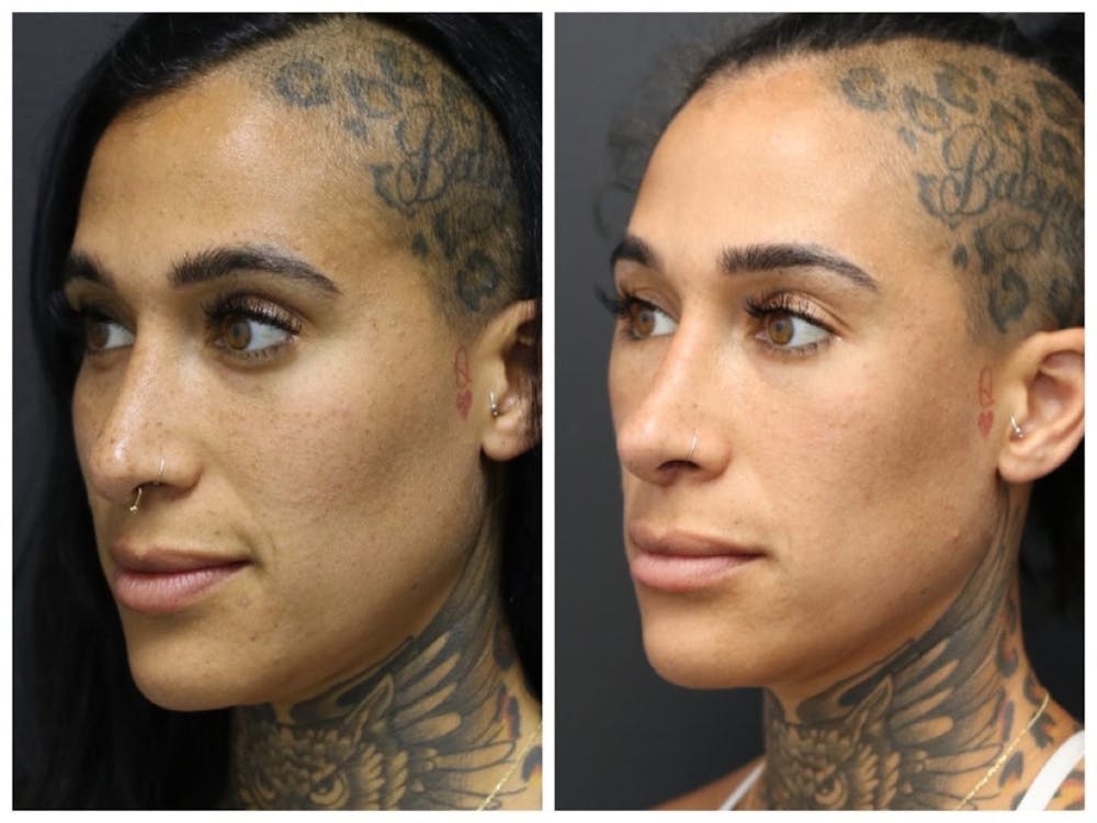 Aesthetic Facial Balancing Before & After Gallery - Patient 11681582 - Image 2