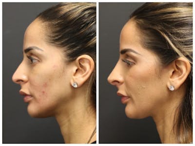 Aesthetic Facial Balancing Before & After Gallery - Patient 11681583 - Image 2