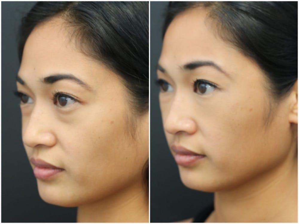 Aesthetic Facial Balancing Before & After Gallery - Patient 11681584 - Image 2