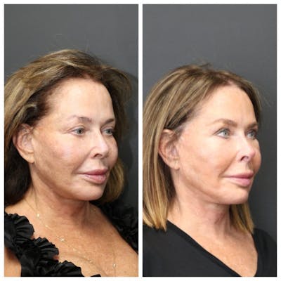 Aesthetic Facial Balancing Before & After Gallery - Patient 11681585 - Image 2