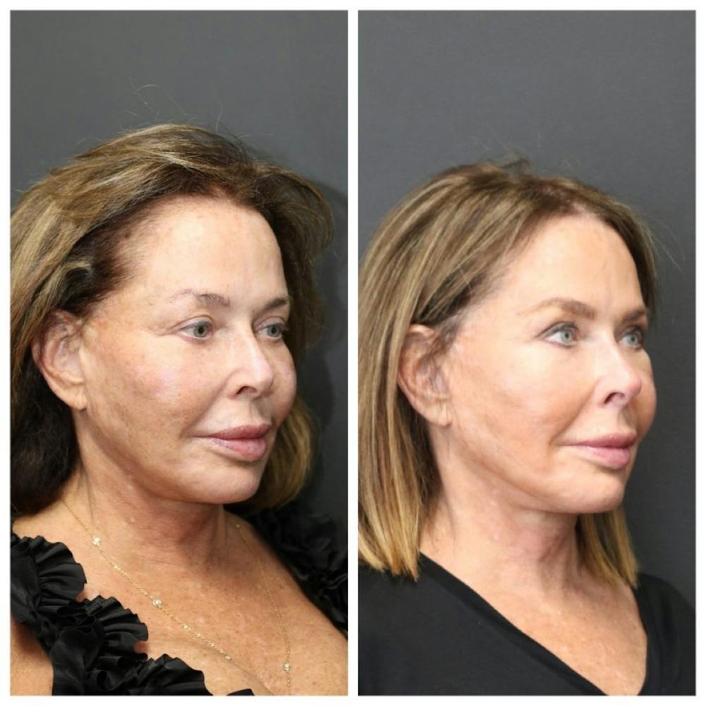 Aesthetic Facial Balancing Gallery - Patient 11681585 - Image 2