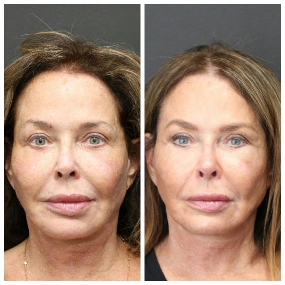 Aesthetic Facial Balancing Before & After Gallery - Patient 11681585 - Image 1