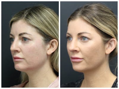Aesthetic Facial Balancing Before & After Gallery - Patient 11681586 - Image 2
