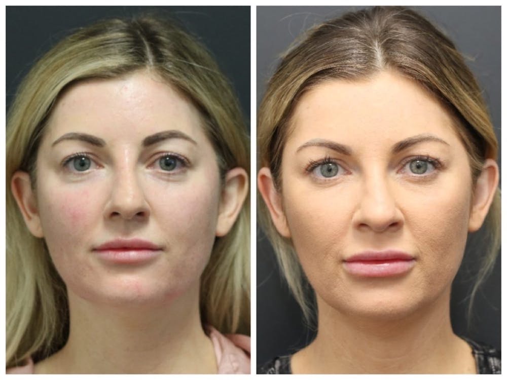 Aesthetic Facial Balancing Before & After Gallery - Patient 11681586 - Image 4