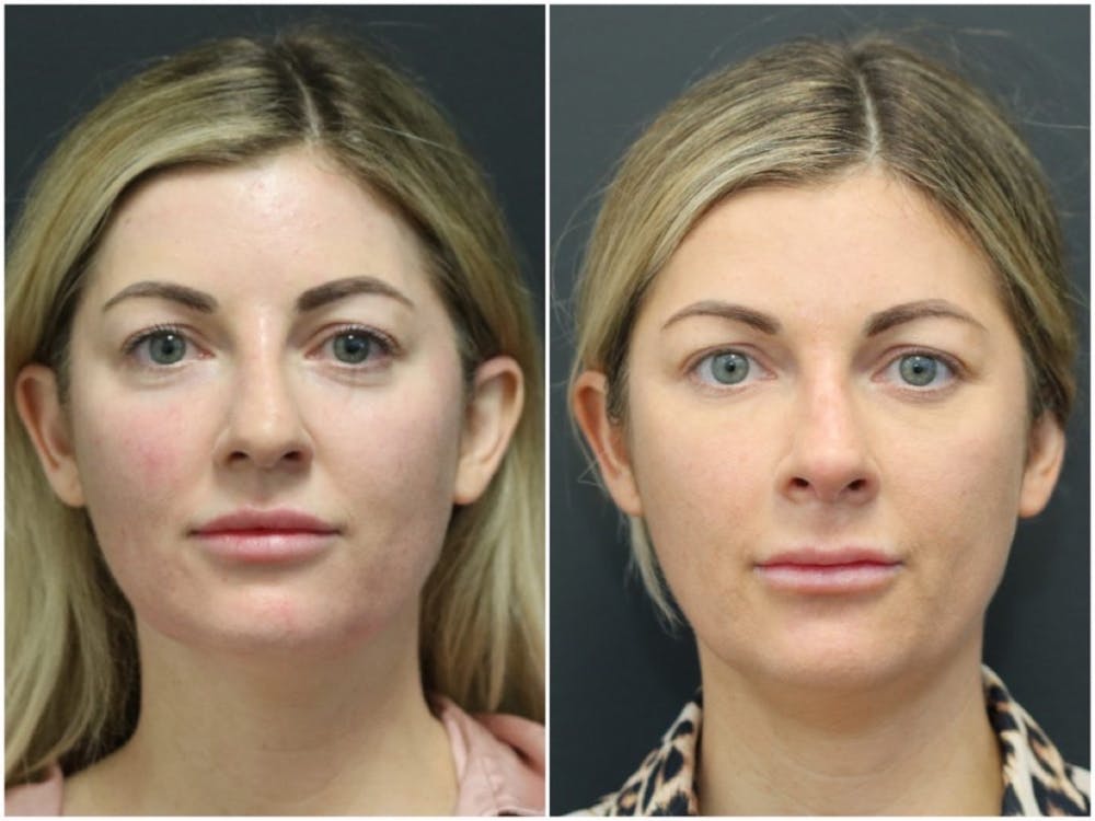 Patient 11681586 | Aesthetic Facial Balancing Gallery | The Maercks Institute Patient 11681586 | Aesthetic Facial Balancing Gallery | The Maercks Institute