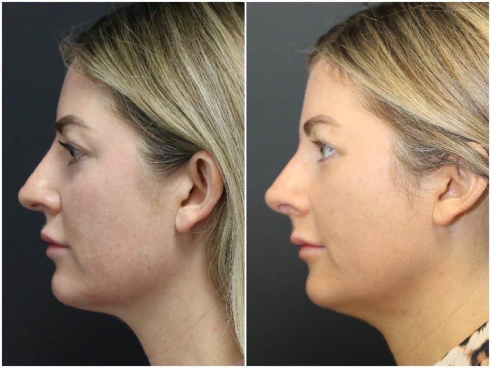 Aesthetic Facial Balancing Before & After Gallery - Patient 11681586 - Image 6