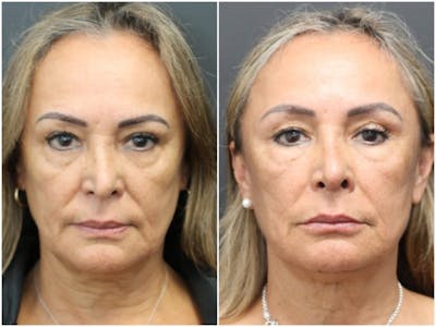Aesthetic Facial Balancing Before & After Gallery - Patient 11681587 - Image 1