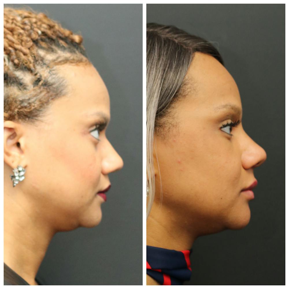 Aesthetic Facial Balancing Before & After Gallery - Patient 11681588 - Image 3