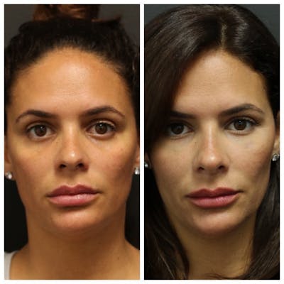 Aesthetic Facial Balancing Before & After Gallery - Patient 11681590 - Image 1