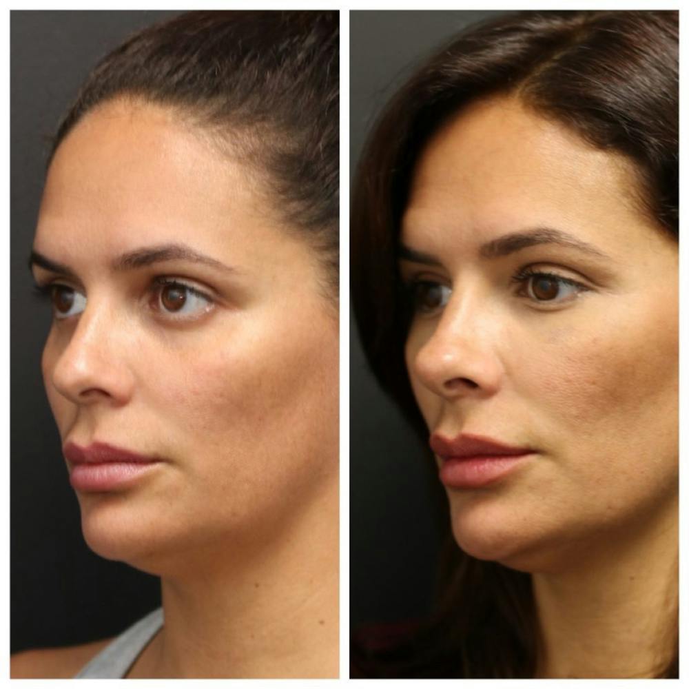 Aesthetic Facial Balancing Before & After Gallery - Patient 11681590 - Image 2