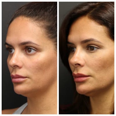 Aesthetic Facial Balancing Before & After Gallery - Patient 11681590 - Image 2
