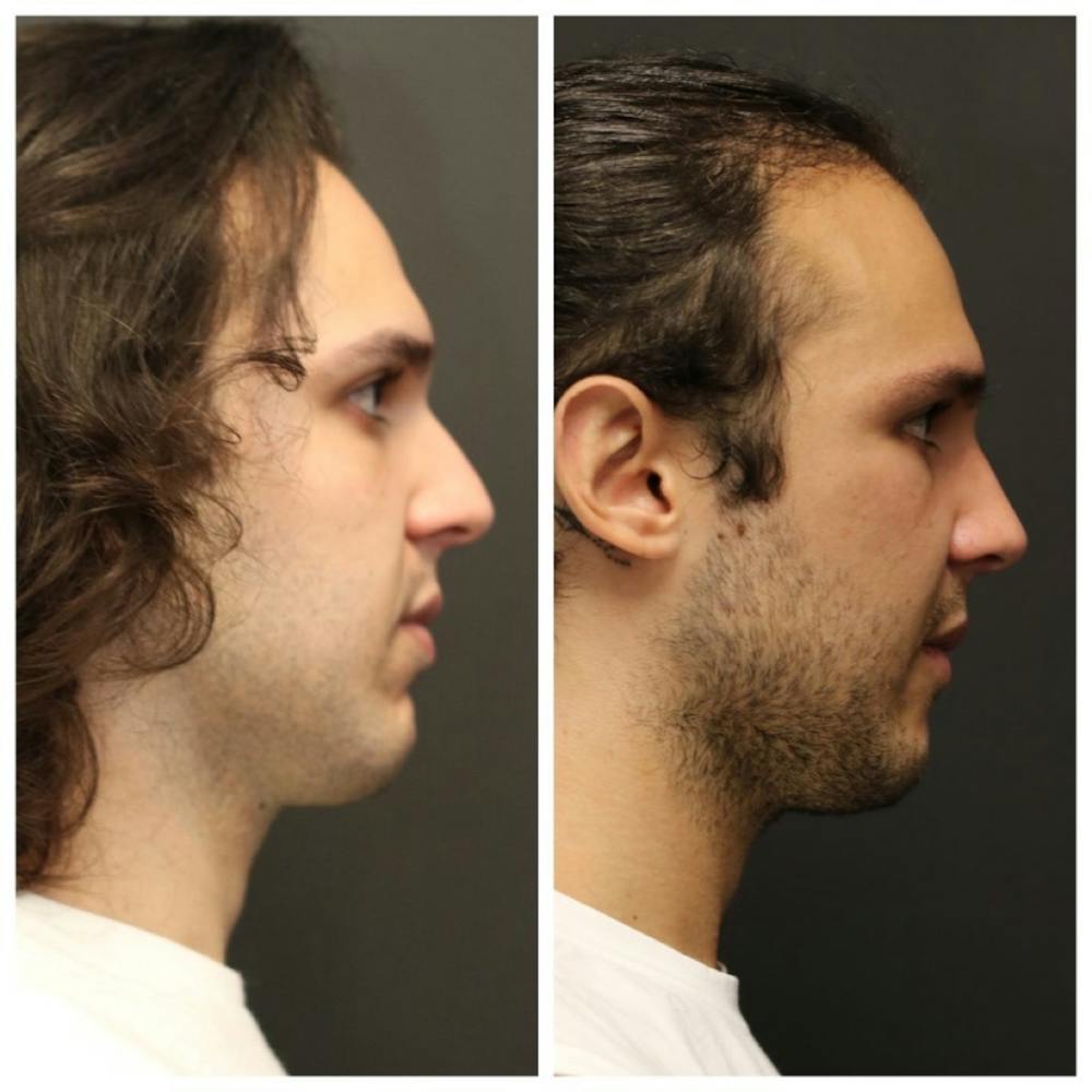 Aesthetic Facial Balancing Before & After Gallery - Patient 11681591 - Image 3