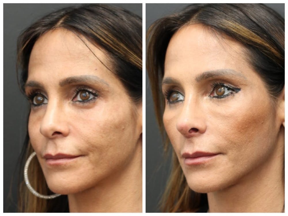Aesthetic Facial Balancing Before & After Gallery - Patient 11681595 - Image 1